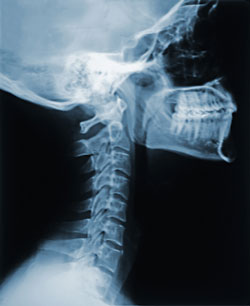 Spinal x-ray